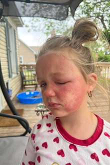 Mum warns against deadly 'poison hemlock' plant after daughter's horrible reaction.