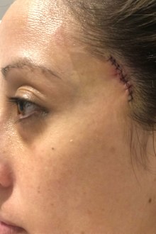 Frances van der Velden's scar after having a skin cancer removed.