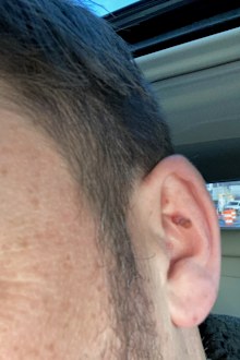 Alexander Gupman had surgery on his ear.