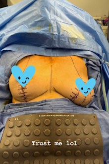 Chrissy Teigen shares behind the scenes snap from breast implant removal surgery.