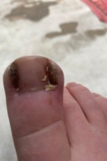 Woman's daughter gets ingrown toenail infected and finds maggots growing on it.