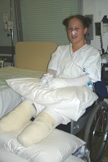 Mel Groenewold in hospital after losing her hands and feet.