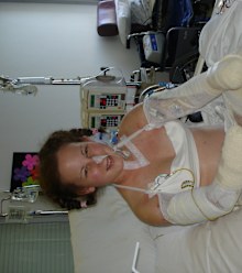 Mel Groenewold in hospital after losing her hands and feet.
