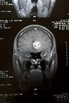 MRI