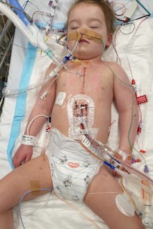 Camilla open heart surgery