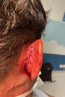 The stitched-up ear of Catalans captain Ben Garcia.