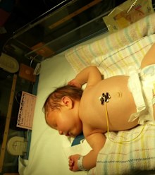 Mia-Rose was born with congenital lymphoedema, causing swelling in her legs and feet.