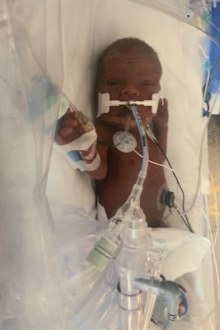 Emilia was born at just 28 weeks gestation.