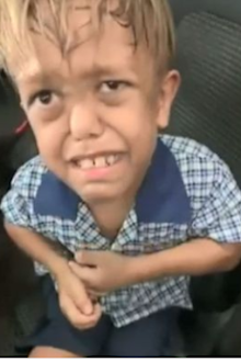 There has been an outpouring of support for Queensland boy Quaden Bayles, who has achondroplasia, after a heartbreaking Facebook video. 