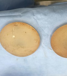 Robyn Smith's implants after being removed.