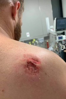 A security worker at Port Macquarie Base Hospital has a deep bite wound on his shoulder.