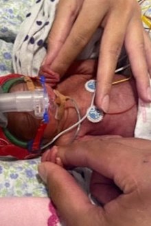 Scarlett premature birth