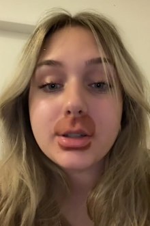 lip flip chemical burns