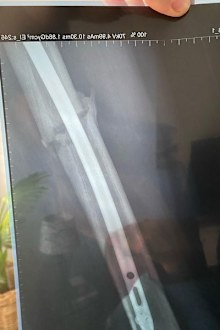 An x-ray of the injury to Jordon Hunt's leg.