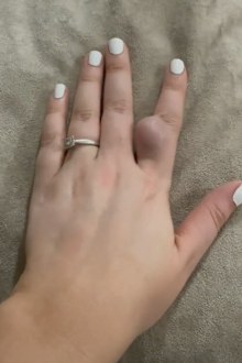 Cyst on finger TikTok