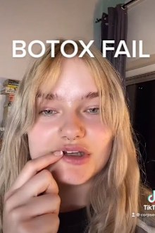 Botox fail shared on TikTok