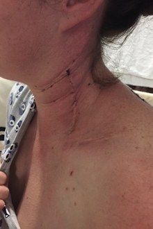 melanoma michelle diagnosis and recovery