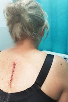 A scar showing where a melanoma and surrounding skin tissue was removed from Gillian Jenkins' back four years ago.