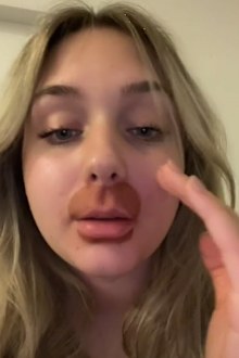 lip flip chemical burns video