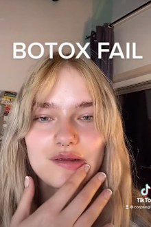 Botox fail in chin