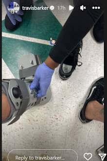 Travis Barker reveals he broke his toe days.