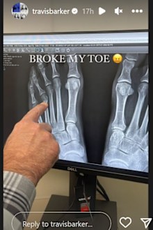 Travis Barker reveals he broke his toe days.