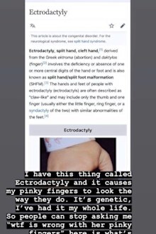 Hailey Baldwin, pinky, health condition, Instagram