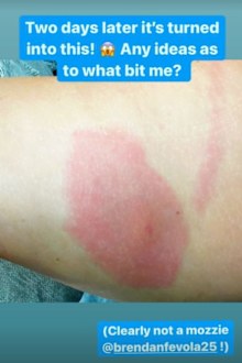 Fifi Box on antibiotics after being bitten by a spider while in bed