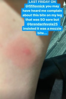 Fifi Box on antibiotics after being bitten by a spider while in bed