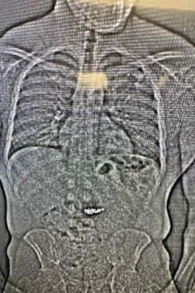 This image provided by the Orlando Police Department shows an x-ray of what are believed to be two diamond earrings that were stolen from a Tiffany & Co. jewelry store in central Florida and were swallowed by the suspect. ( Orlando Police Department office via AP)