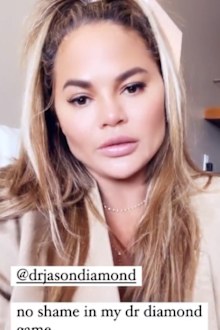 Chrissy Teigen reveals she got fat removed from her cheeks