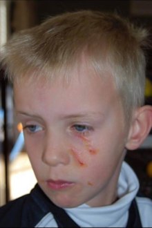 Ben Hynes was left with several scratches to his face after a magpie went against normal swooping behavior and targeted his face.  