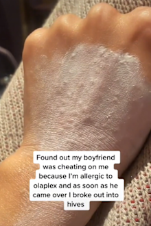 Boyfriend cheating sign rash hives