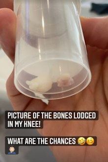 Singer Olly Murs shares grisly photo of bone 'fragments' after suffering horrific onstage accident.