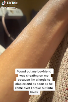 Boyfriend cheating sign rash hives