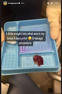 Nick Kyrgios reveals the gross extent of his knee issue.