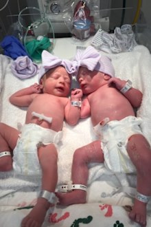 Twins Emma and Julia, shortly after their birth. 