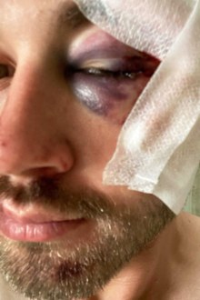 Cameron Johnson showing the damage done to his left eye.