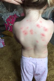 Chickenpox treatment