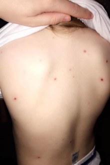 Chickenpox treatment