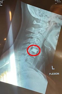 Tamara Watkins was suffering from extremely painful headaches, back pain and nausea before an MRI showed a bone spur was growing into her spine. This x-ray shows her spine after surgery.