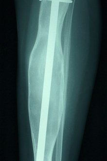 Metal Rod in Leg X-Ray