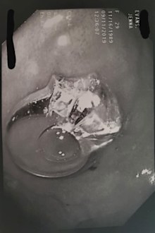 Woman swallows engagement ring in her sleep, needs surgery