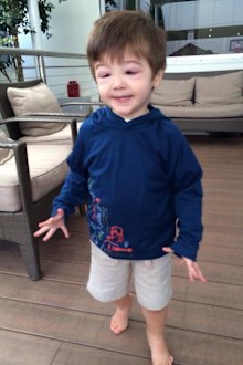 Caroline von Bibra thought her son, Lachie, had hay fever when his face started swelling up.