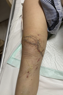 Jordon Hunt's leg after surgery.