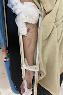 Jordon Hunt's leg in a splint.