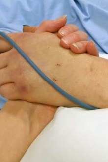 Amanda Stacey's sister holds her hand while she is in a coma.