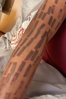 Laser hair removal bans