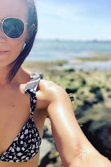 Claire eczema selfie
