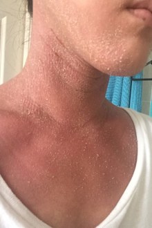 Early stages of withdrawal: flaky red skin, cracks forming.